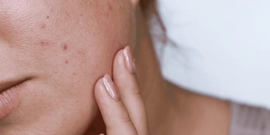 Comprendre l'acné et les boutons - Beseed