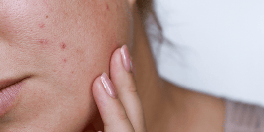 Qu’est-ce qu’un bouton d'acné et qu’est-ce qui les provoque ? - Beseed